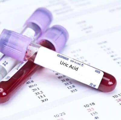 Uric Acid Blood Test Sample photo