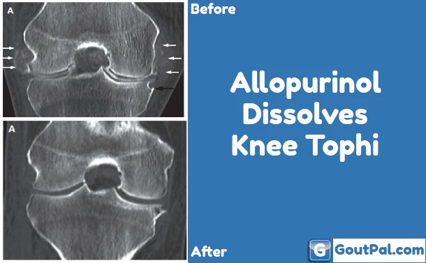 Allopurinol Dissolves Knee Tophi