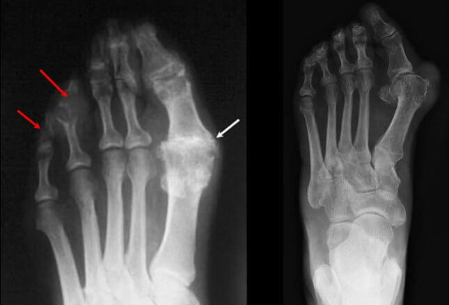 Gout, Bunion, or both X-rays