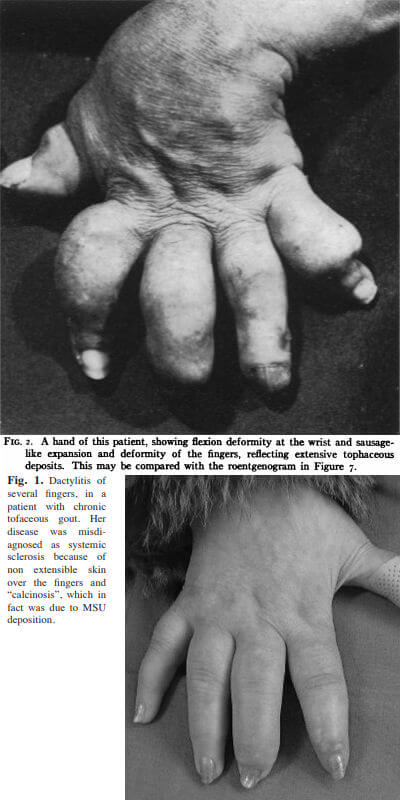 Gout with "sausage-finger" photos