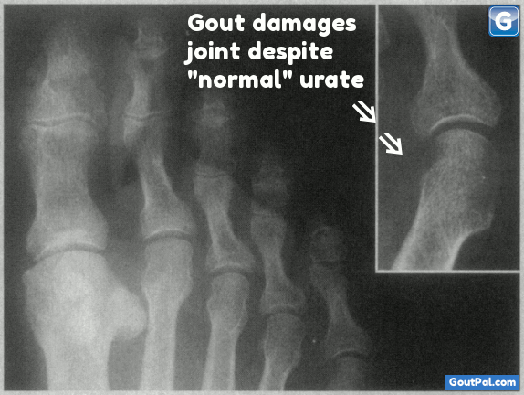 Normal Urate Levels Destroy Bone X-ray Image
