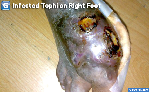 Infected Tophi On Right Foot Photograph