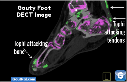 Running with Gout Foot DECT Image