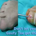 Toe Tophi Surgery on Gout Victim
