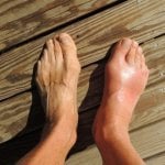 3 Unusual Signs Of Gout