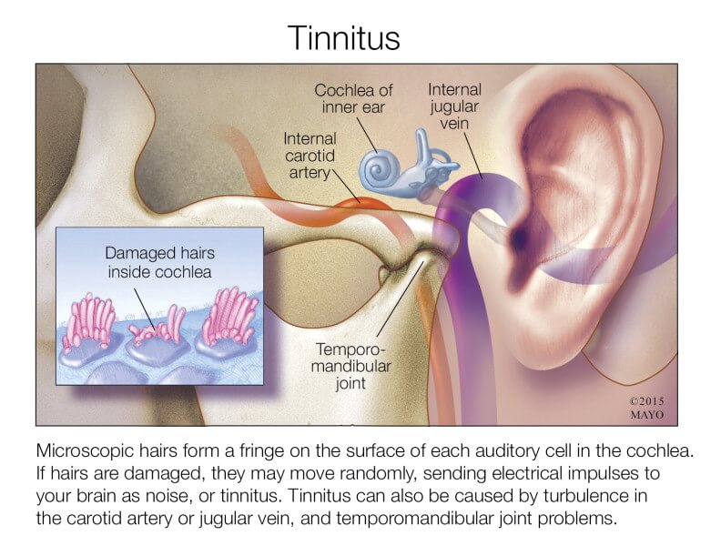 Can Gout Drugs Cause Tinnitus media