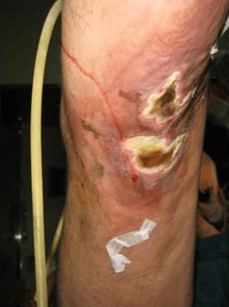 Contagious Septic Arthritis Mimics Gout