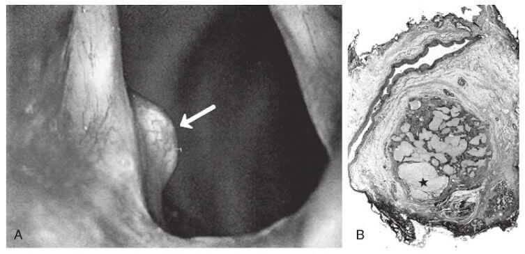 Gouty Tophi in Larynx