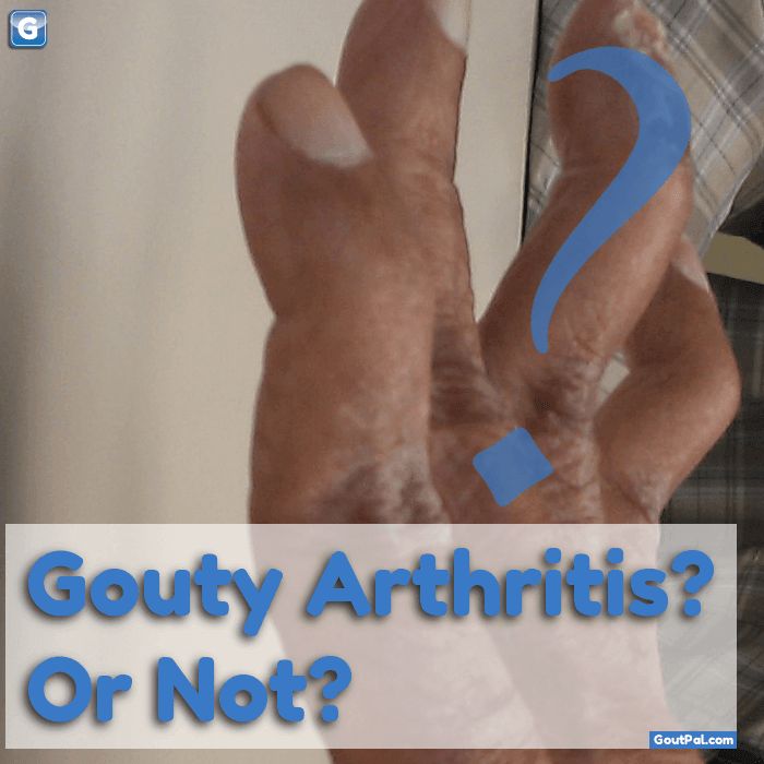 Gouty Arthritis Or Not photo
