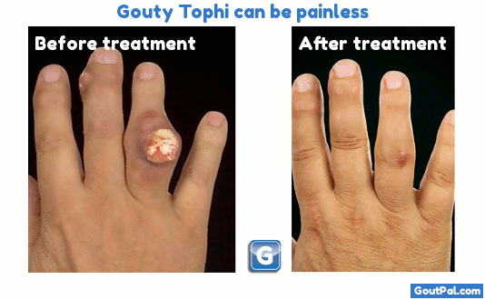 Gouty Tophi can be Painless photo