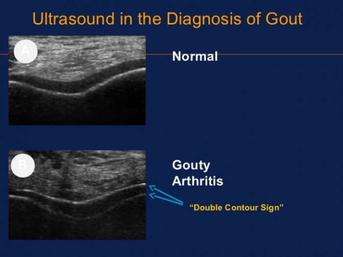 Ultrasound of early chronic gout duration timeline