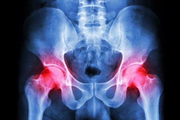 Gout pain travels to Hip Joint. Which Joint gets Gout Next?