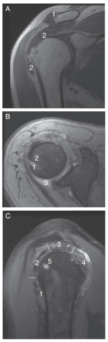 Shoulder in Gout MRI images