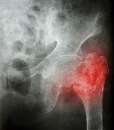 Gout and Hip Fractures X-ray