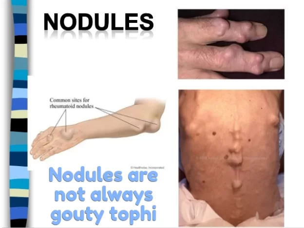 Nodules are not always gouty tophi