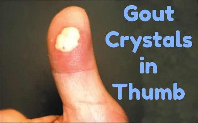 Gout Crystals in Thumb